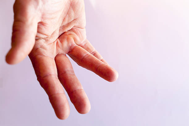 Dupuytren's Contracture