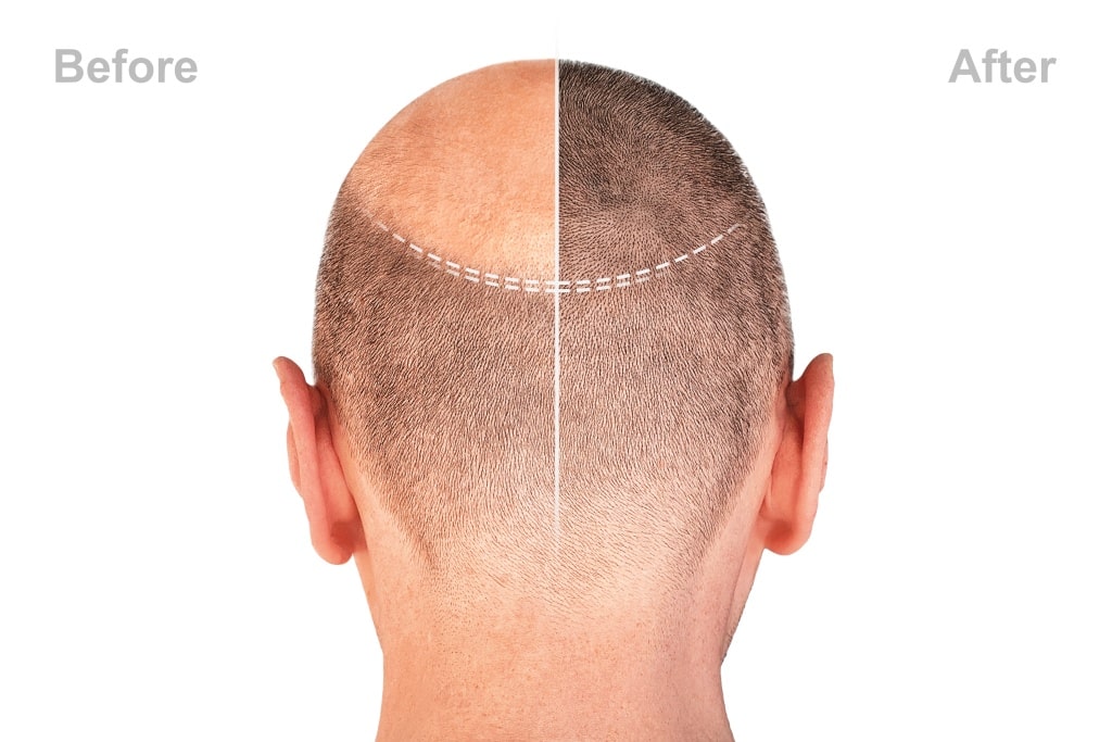 Scalp Micropigmentation before and after