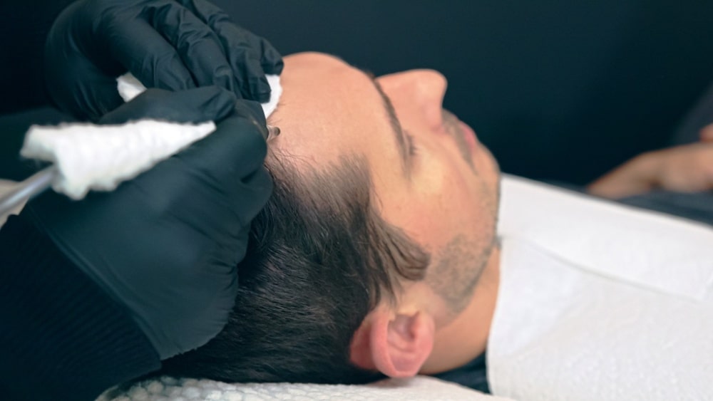 Scalp Micropigmentation