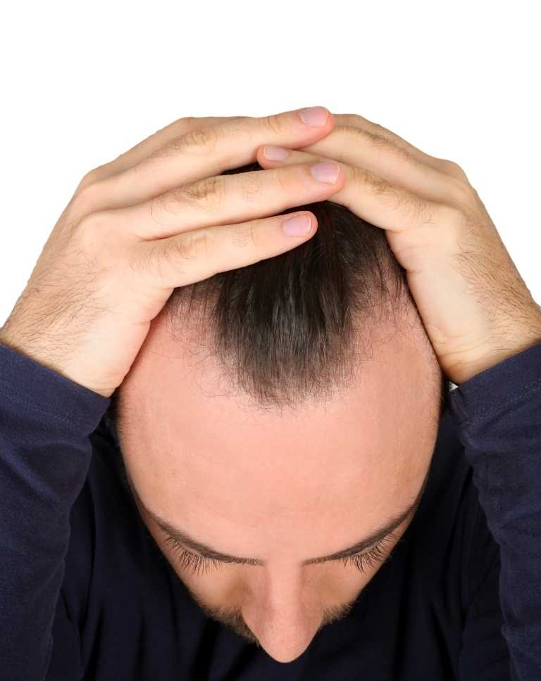 Finasteride Hair Loss Treatment (1)