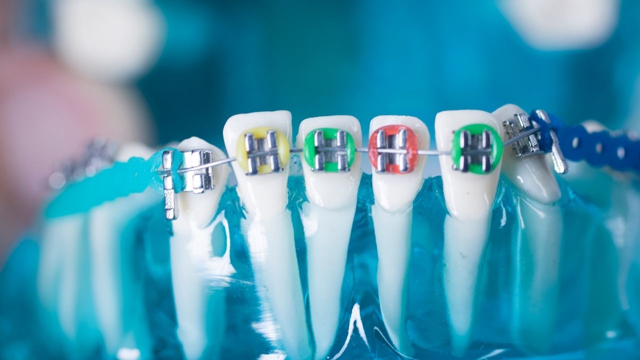 Dental teeth straightening