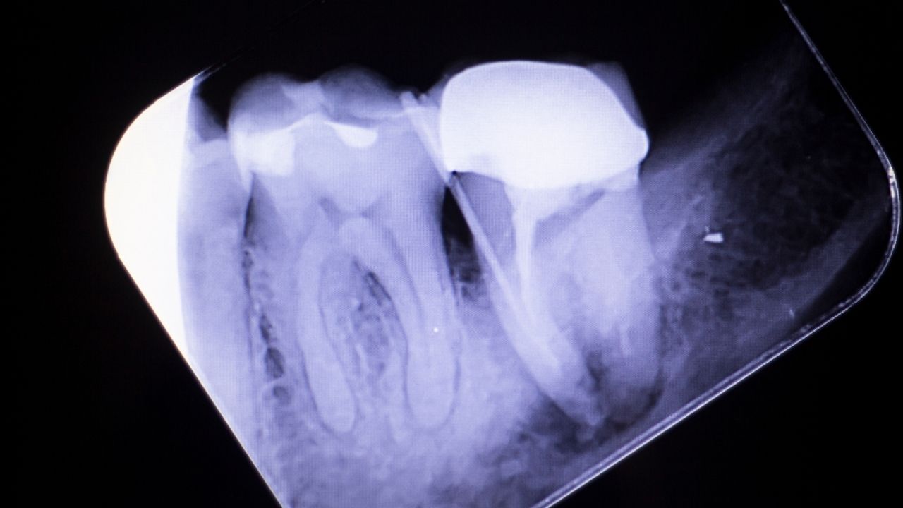 Tooth crown root canal