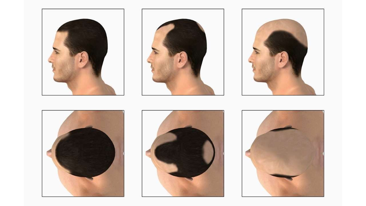 Male Pattern Baldness