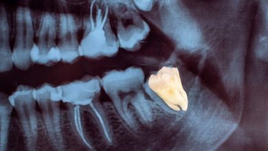 Wisdom Tooth