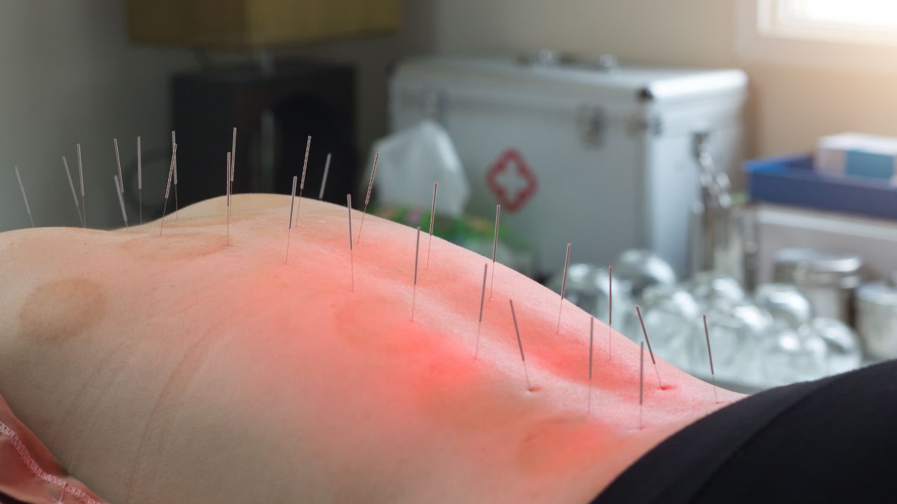 Acupuncture Clinic