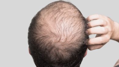 Male Pattern Baldness