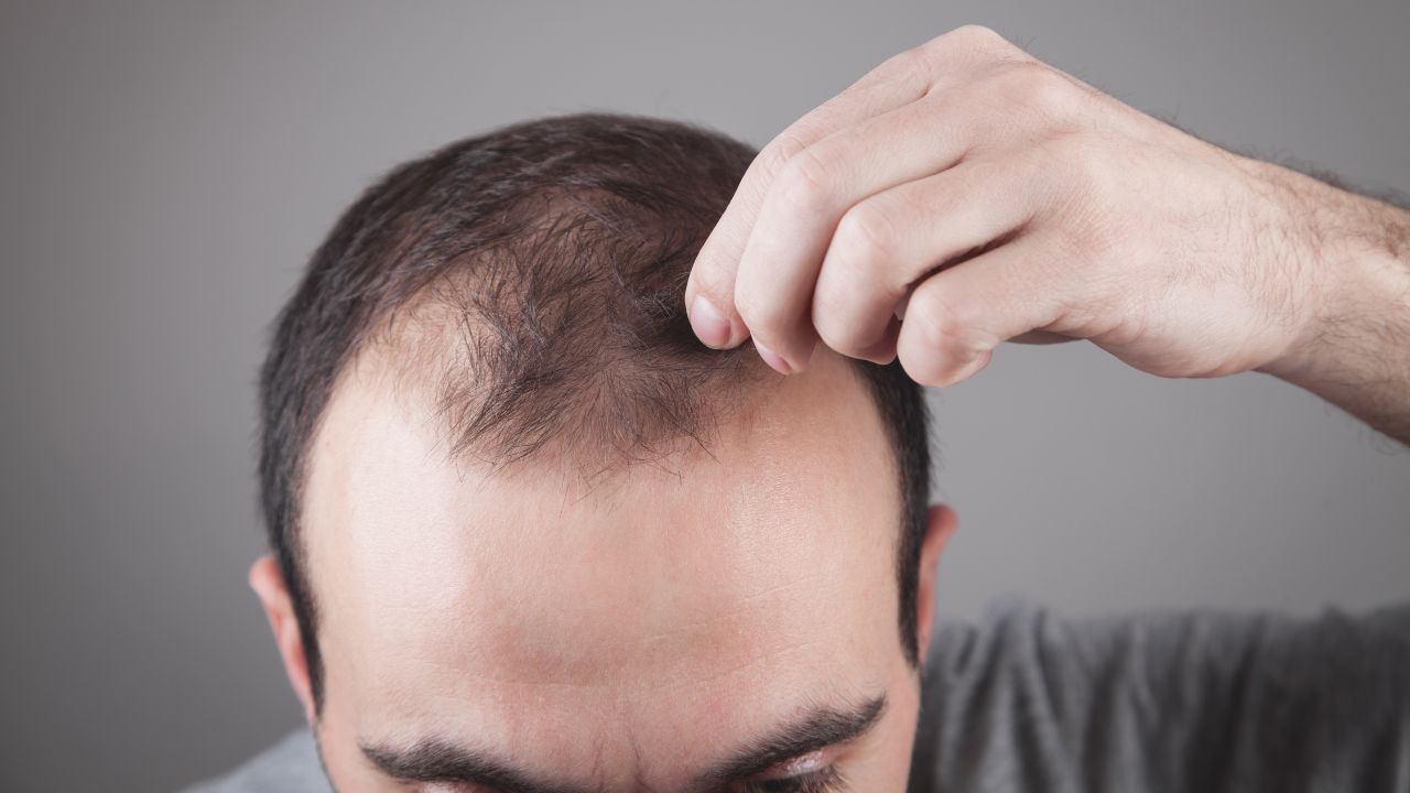 Hair Loss in guy