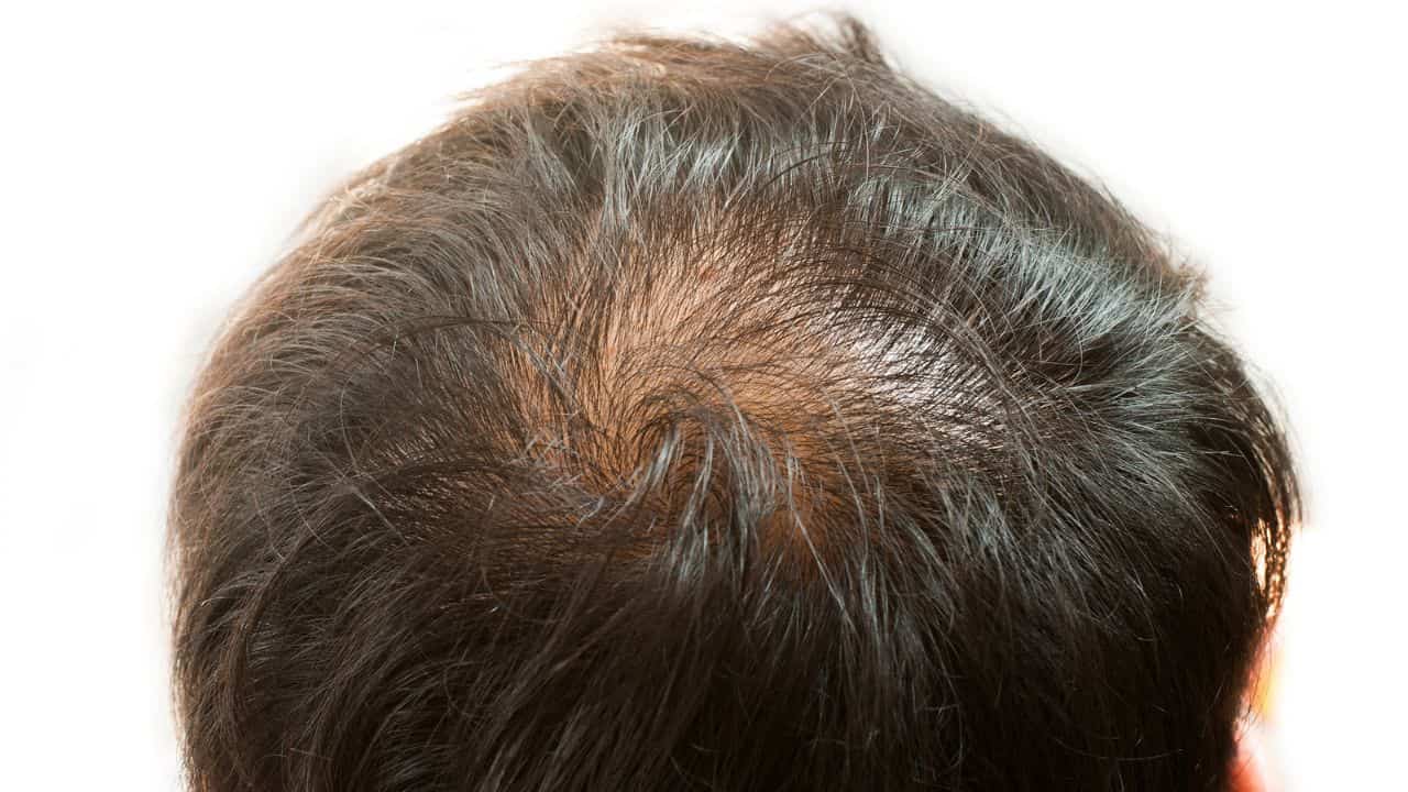 scalp of a guy