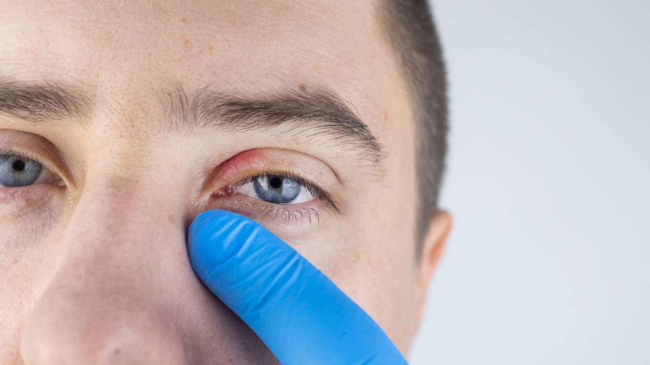 doctor checking patient who has Demodex Blepharitis